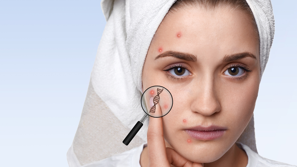 “nutrigenomics & acne: dna diet solutions for clear skin