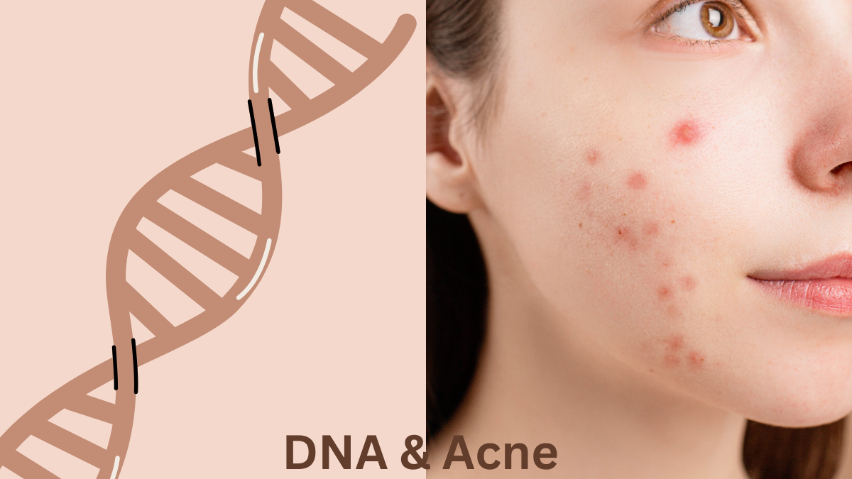“7 powerful genetic variants that trigger acne breakouts”