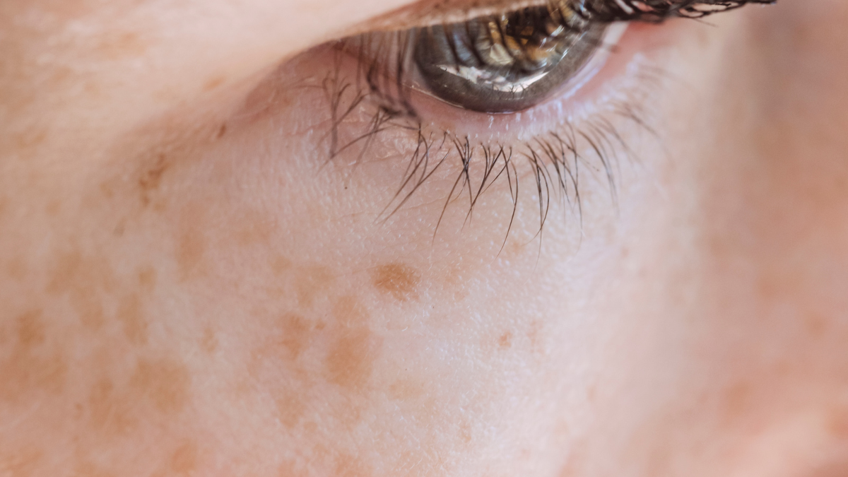 “taking vitamin d but skin is getting darker? The gene truth”