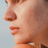 Ceramides vs peptides for oily skin barrier repair