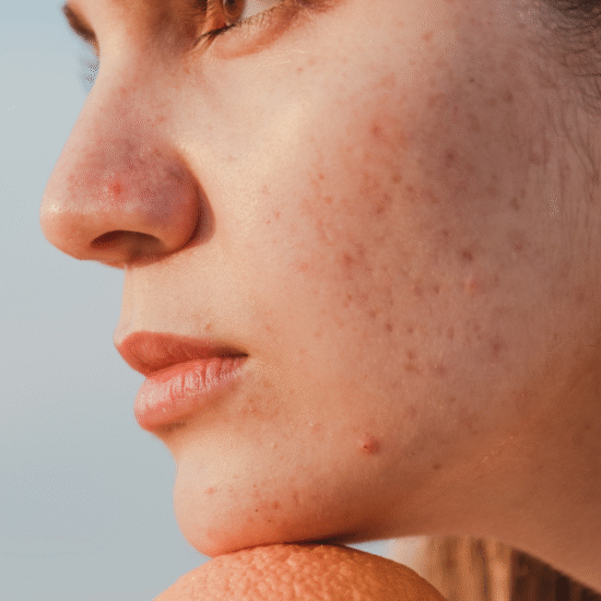 Ceramides vs peptides for oily skin barrier repair