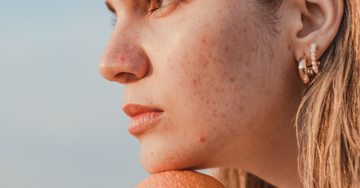 Ceramides vs peptides for oily skin barrier repair