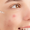 Best cleanser for acne-prone skin in humidity (no breakouts)