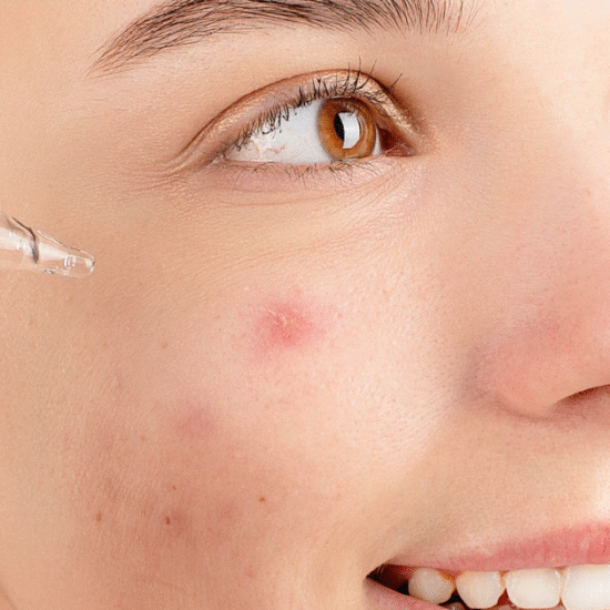 Best cleanser for acne-prone skin in humidity (no breakouts)