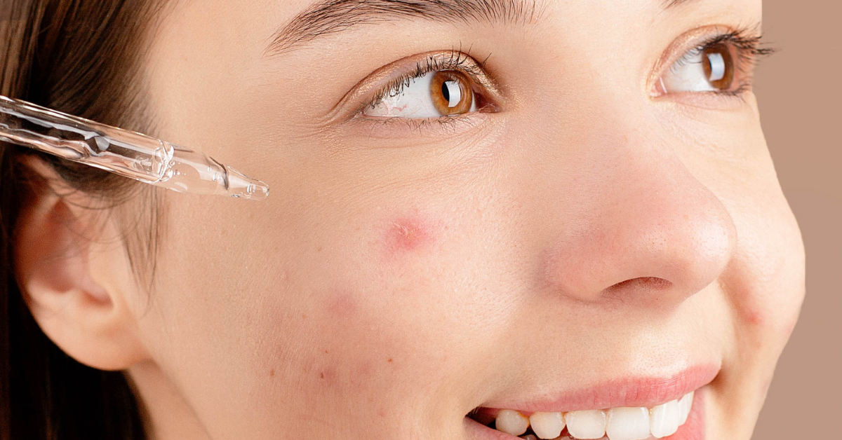 Best cleanser for acne-prone skin in humidity (no breakouts)